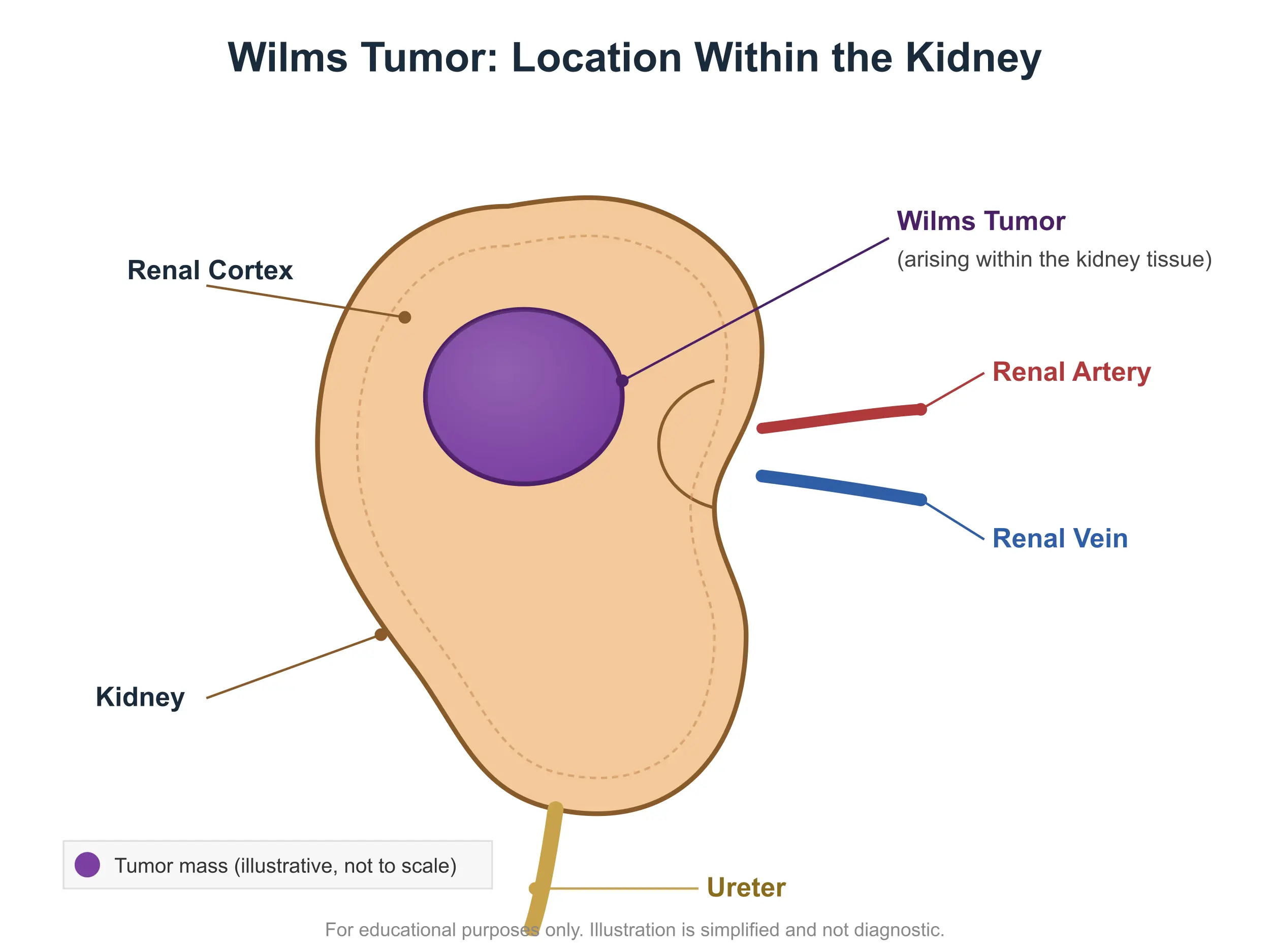 llustration showing the location of a Wilms tumor (nephroblastoma) developing inside a child's kidney, with labels for the renal cortex, renal artery, renal vein, and ureter.
