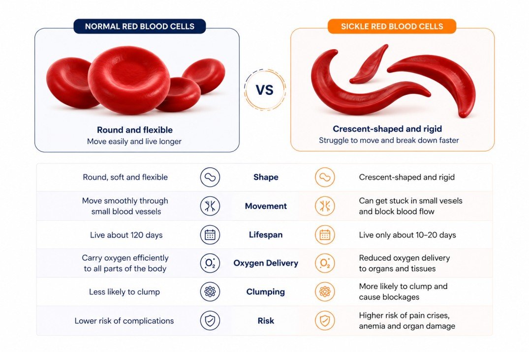 Sickle cell anemia infographic comparing normal red blood cells and sickle-shaped red blood cells, showing blood flow changes, reduced oxygen delivery, anemia, and complications.