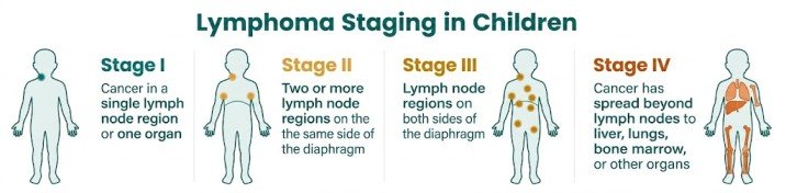 Lymphoma staging in children infographic showing Stage I to Stage IV progression from single lymph node to organ spread